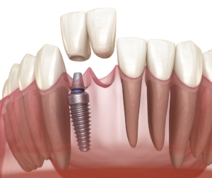 dental implants